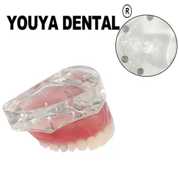 Модель восстановления верхних зубов на зубных имплантатах Съемный мостовидный протез зубов Модель для обучения зубного техника