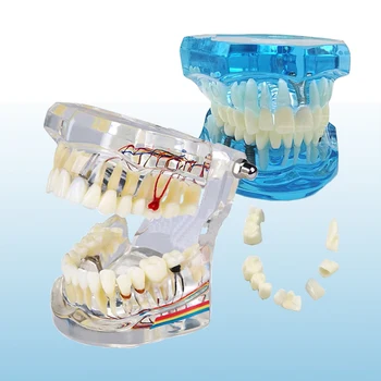 Стоматологическая патологическая модель зубов Реставрация зубов на имплантатах Модель зубов Стоматологическое обучение Зубные стоматологи Учебные ресурсы